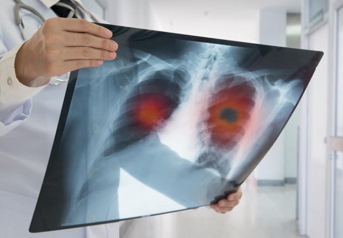 Srpska doktorica otkrila kako da prepoznate asimptomatsku upalu pluća