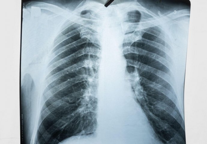 Srpska doktorica: Ovi simptomi najavljuju asimptomatsku upalu pluća - Iako na snimku nema ništa, vi ste zaraženi