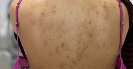 POJAVILE SU VAM SE BUBULJICE NA LEĐIMA? NIJE BEZAZLENO: Evo šta vam se događa u organizmu!