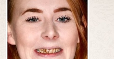 SKUPILA SAM 3000 KM I KONAČNO SE NAKON 3 GODINE OSVETILA BIVŠEM DEČKU: Kad je vidio sliku nakon ugradnje novih zuba, pojeo se od muke (FOTO)