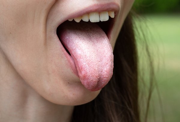 white-coated-tongue-causes-feat