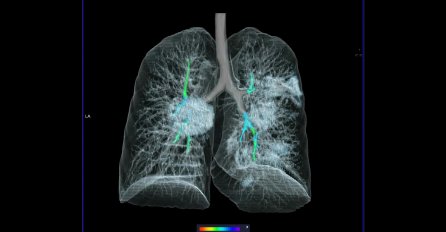 Teški oblici COVID-a: Doktor upozorava - obratite pažnju na redoslijed ovih simptoma