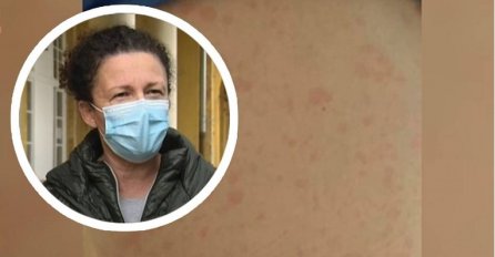 Majka iz Pule: Sin mi je prehodao koronu. Onda je dobio osip, oči su mu otekle