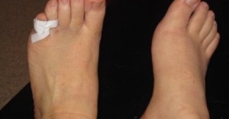 Novo istraživanje otkrilo je jedan neobični simptom koronavirusa: Promjene na nožnim prstima kod oboljelih od covida mogu trajati mjesecima