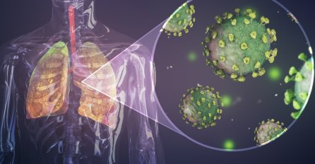 Pored upale pluća, korona uzrokuje još 9 komplikacija: Naučnici uporedili 70.000 pacijenata