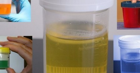 Evo šta boja urina otkriva o vašem zdravlju: Ova boja je znak za uzbunu