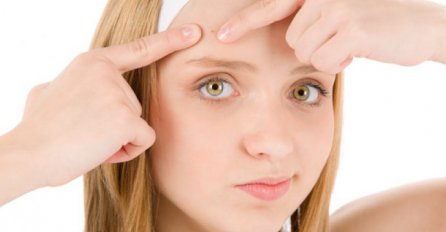 STIDITE SE OŽILJAKA OD AKNI? EVO KAKO DA IH UKLONITE: Lice će ponovo biti čisto, SVE SASTOJKE VEĆ IMATE U KUHINJI!