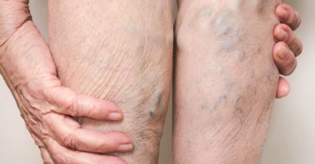 OPREZNO: Žene koje imaju IZRAŽENE VENE na nogama su u OPASNOSTI koju mogu da SPRIJEČE