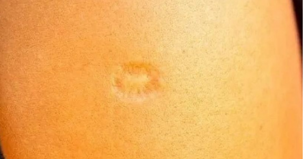 Ako ste rođeni u JUGOSLAVIJI SIGURNO IMATE OVAJ OŽILJAK NA RUCI: Znate li kako je nastao?