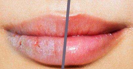 SPRIJEČITE I LIJEČITE ISPUCALE USNE: Recept za prirodni balzam s dva moćna sastojka u tri koraka!