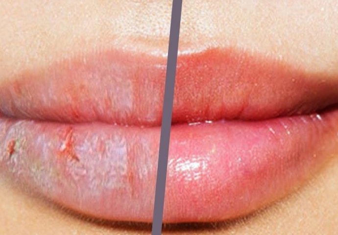 SPRIJEČITE I LIJEČITE ISPUCALE USNE: Recept za prirodni balzam s dva moćna sastojka u tri koraka!