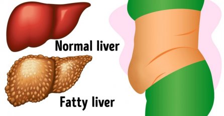 LJEKARI TVRDE: Ako se jedu često, ove namirnice mogu da naruše zdravlje jetre