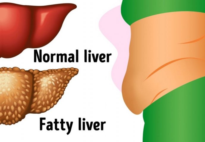 LJEKARI TVRDE: Ako se jedu često, ove namirnice mogu da naruše zdravlje jetre