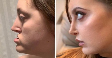 20 LJUDI OTIŠLO KOD PLASTIČARA - operisali vilicu, nos, usne, ŽESTOKO SE TRANSFORMISALI: Slike broj 17 i 18 SU VELIKO IZENENAĐENJE, OSTAT ĆETE BEZ TEKSTA