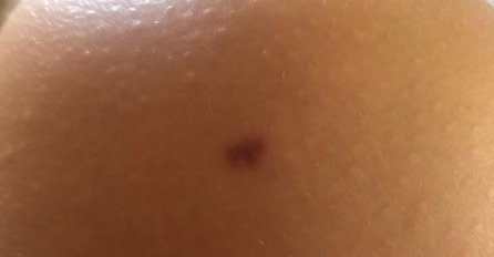 Dermatolog odgovorio: Evo da li smijemo čupati DLAČICE KOJE RASTU IZ MLADEŽA?!
