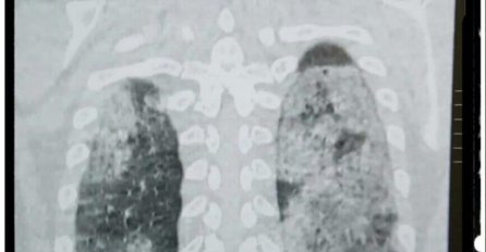 Ovo je CT pluća jednog od 430 hospitalizovanih u KS - mlad čovjek, nepušač: Za one koji ne znaju, zdrav je crni dio