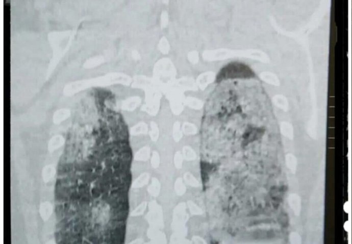 Ovo je CT pluća jednog od 430 hospitalizovanih u KS - mlad čovjek, nepušač: Za one koji ne znaju, zdrav je crni dio