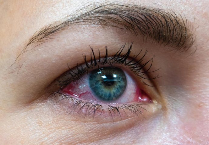 OVAJ SIMPTOM NE SMIJETE IGNORISATI: Crvenilo očiju može da bude PRVI ZNAK OVE BOLESTI!
