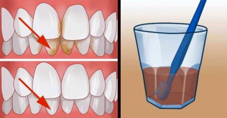 NATALOŽENI KAMENAC MOŽETE UKLONITI SAMI KOD KUĆE! Potreban vam je samo JEDAN SASTOJAK KOJI VEĆ IMATE U KUĆI!