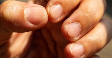 POGLEDAJTE SVOJE NOKTE: Ako imate OVO na njima, sasvim je moguće da ste PRELEŽALI virus - tvrde naučnici!