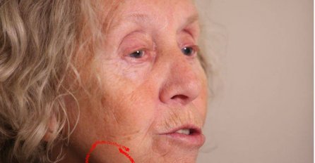 Prvi SIMPTOM RAKA kože: Eva Ras POKAZALA PROMJENU na licu koja je znak opake bolesti (FOTO)