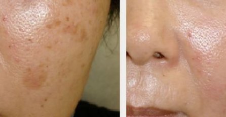 Recite zbogom STARAČKIM PJEGAMA: Pomoću ove maske dobićete ten iz snova (RECEPT)