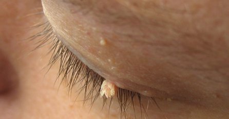 NAJBOLJI PRIRODNI LIJEK ZA BRADAVICE, NESTAJU U TRENU! Samo budite uporni i vidjećete kako nestaju