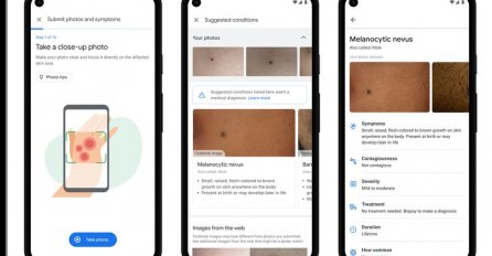 Google ima novu aplikaciju koja će pomoći korisnicima da prepoznaju STANJE KOŽE!