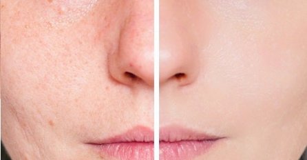 Problemi sa OŽILJCMA NAKON AKNI? Spriječite njihovo pojavljivanje uz ove savjete