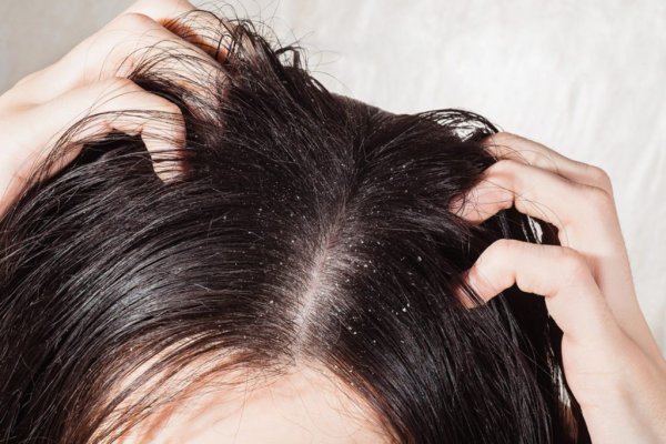 10-dandruff-surprising-reasons-why-your-hair-is-greasy-373934782-goncharov-artem-1024x683