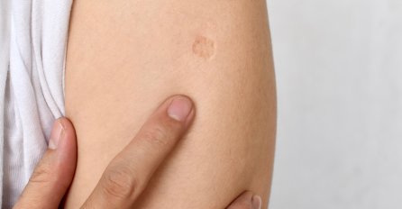 AKO STE ROĐENI U JUGOSLAVIJI ONDA SIGURNO IMATE OVAJ OŽILJAK NA RUCI: Znate Li Od Čega?