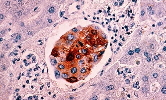 breast-cancer-cells-012