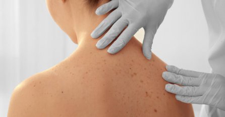 DOBRO PREGLEDAJTE PJEGE NA KOŽI: Dermatolog objasnila kako da razlikujete bezazlene od opasnih