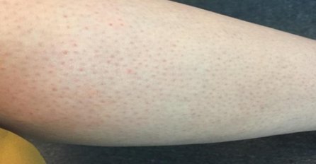 DOSADILE SU VAM SITNE DLAČICE NA NOGAMA? OTKRIVAMO VAM TRIK KAKO DA SPORIJE RASTU: Tako jednostavno, a tako efikasno