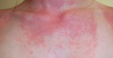 4 ZNAKA DA MOŽDA IMATE ALERGIJU NA SUNCE, A TO NI NE ZNATE! Dr Rašković upozorava na simptome koje ne smijete ignorisati!