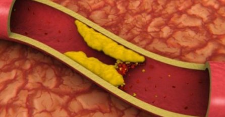 2 SIMPTOMA OTKRIVAJU VISOK HOLESTEROL I BEZ ANALIZE KRVI: Ljekari upozorili na skrivene signale koje ne smijete ignorisati
