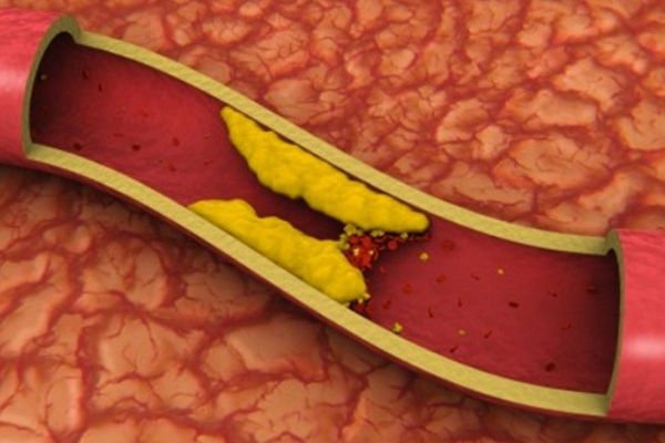 krvni-sud-holesterol