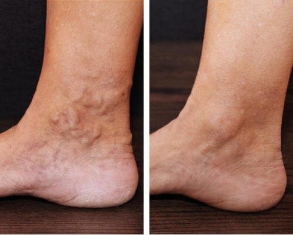varicose-veins-what-are-they-and-what-you-can-do-about-them-dallasveinspecialists