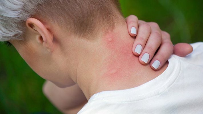 why-mosquito-bites-itch-and-how-to-get-relief-722x406