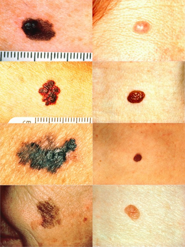 melanoma-vs-normal-mole-abcd-rule-nci-visuals-online-768x1024