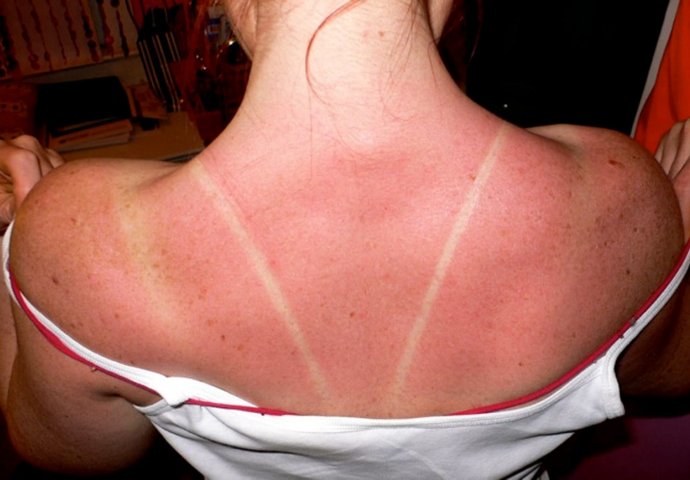 NEMA BRIGE, RJEŠENJE JE PRI RUCI: Dermatolozi otkrili najbolje kućne lijekove za opekline od sunca
