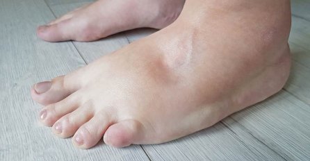MNOGIM ŽENAMA NA VRUĆINI OTIČU NOGE:  Ovo je UZROK i lako se može spriječiti, EVO ŠTA TREBATE URADITI!