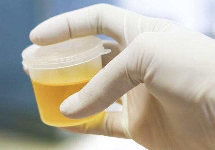 BOJA URINA otkriva mnoge ozbiljne bolesti, pa čak i RAK: 7 RAZLOGA zbog kojih vam je MOKRAĆA MUTNA