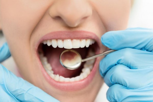 woman-having-cavities-inspected-by-dentist-wanting-to-use-home-remedies