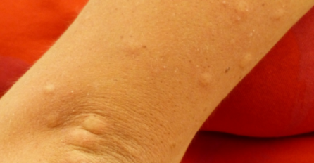 NISTE SIGURNI IMATE LI SVRAB? Provjerite koji su simptomi ove neugodne kožne bolesti!
