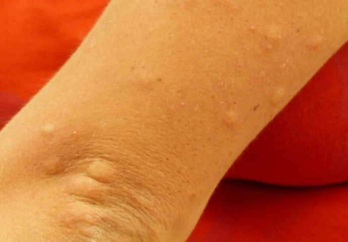 NISTE SIGURNI IMATE LI SVRAB? Provjerite koji su simptomi ove neugodne kožne bolesti!