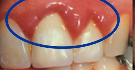 NATEČENO ZUBNO MESO ZNA BITI JAKO BOLNO: Evo šta trebate uraditi da se povuče, NE IGRAJTE SE SA OVIM STANJEM