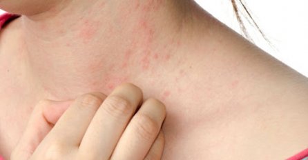 Bockanje, crvene kvržice i svrab su simptomi OSIPA ZBOG VODE: Da li je opasan i koliko traje otkriva dermatolog
