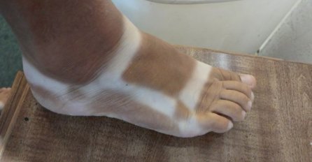 BOLJE DA NISU IZ KUĆE IZLAZILI, OVO SU NAJKOMIČNIJE OPEKOTINE OD SUNCA: Kad vidite momka broj 3. SUZE ĆE VAM KRENUTI