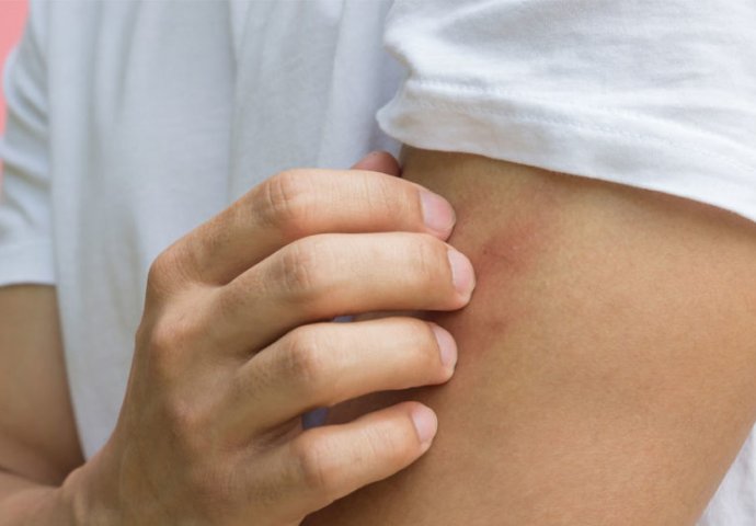 MNOGI NE OBRATE PAŽNJU NA SVRAB, ALI MOŽE BITI SIMPTOM OPASNE BOLESTI: Ovo je 10 razloga zbog čega koža može da svrbi